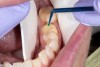 Fig 15. Application of a tooth primer on the tooth before the use of a conventional resin cement. Isolation was achieved with cardboard cheek retractors in the buccal and lingual vestibules.